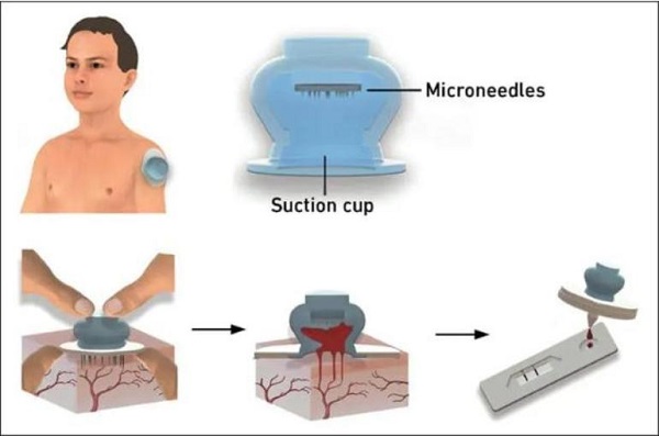 Thiết bị lấy mẫu máu mới lấy cảm hứng từ loài đỉa